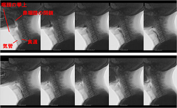 嚥下造影検査（VF検査）
